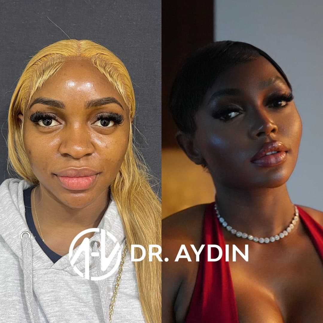 Rhinoplasty procedure