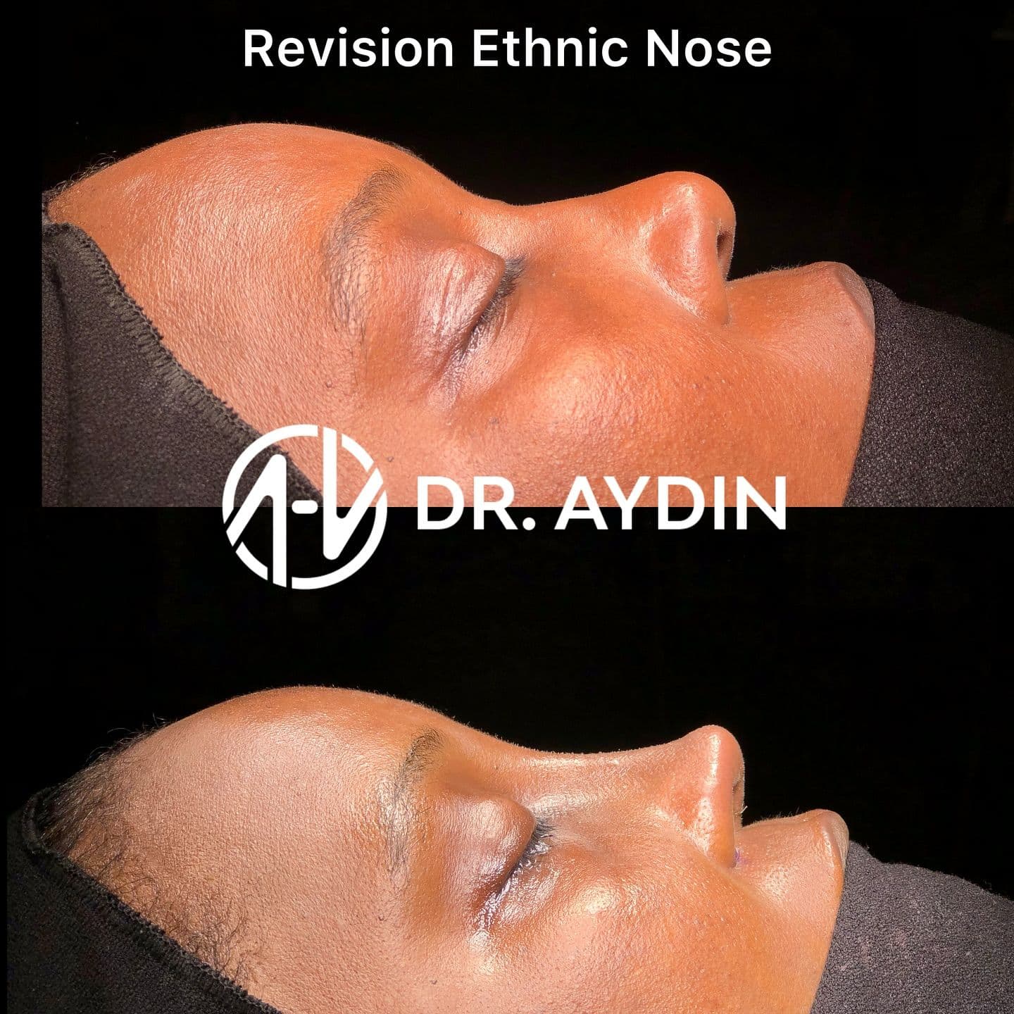 Rhinoplasty clinic Instagram photo — Op. Dr. Ahmet Halit Aydın