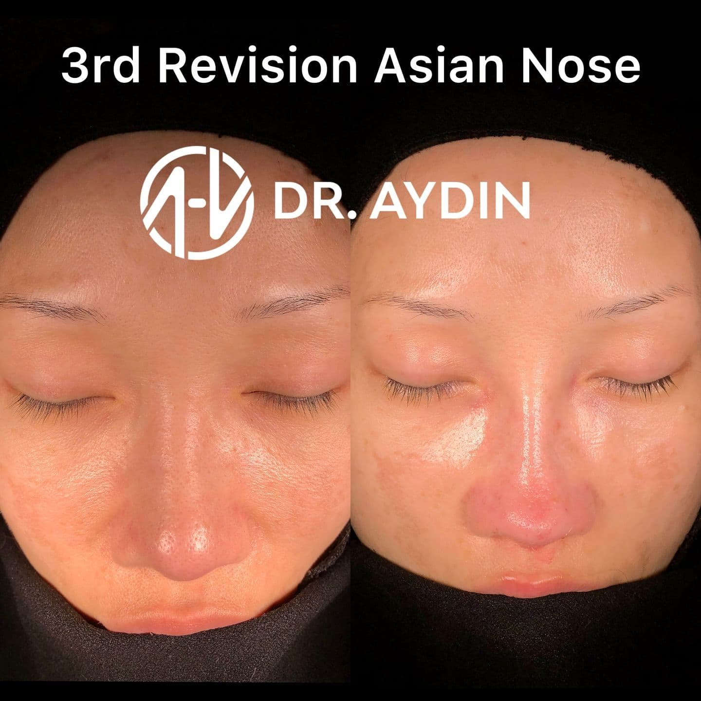 Rhinoplasty clinic Instagram photo — Op. Dr. Ahmet Halit Aydın